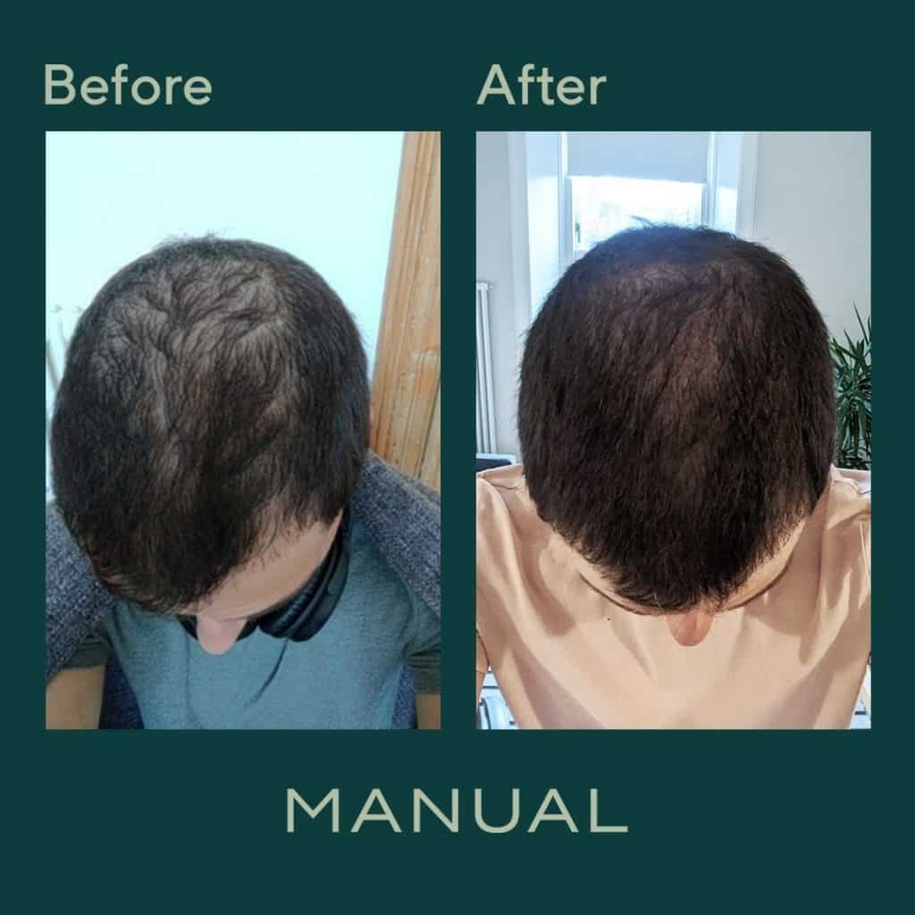 Manual Hair Loss Treatments Review