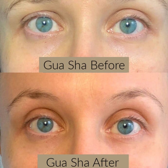 Gua Sha Before and After: Benefits and Results