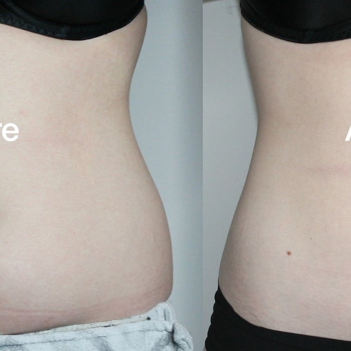 Coolsculpting Before and After: Results, Side Effects, and What to Expect